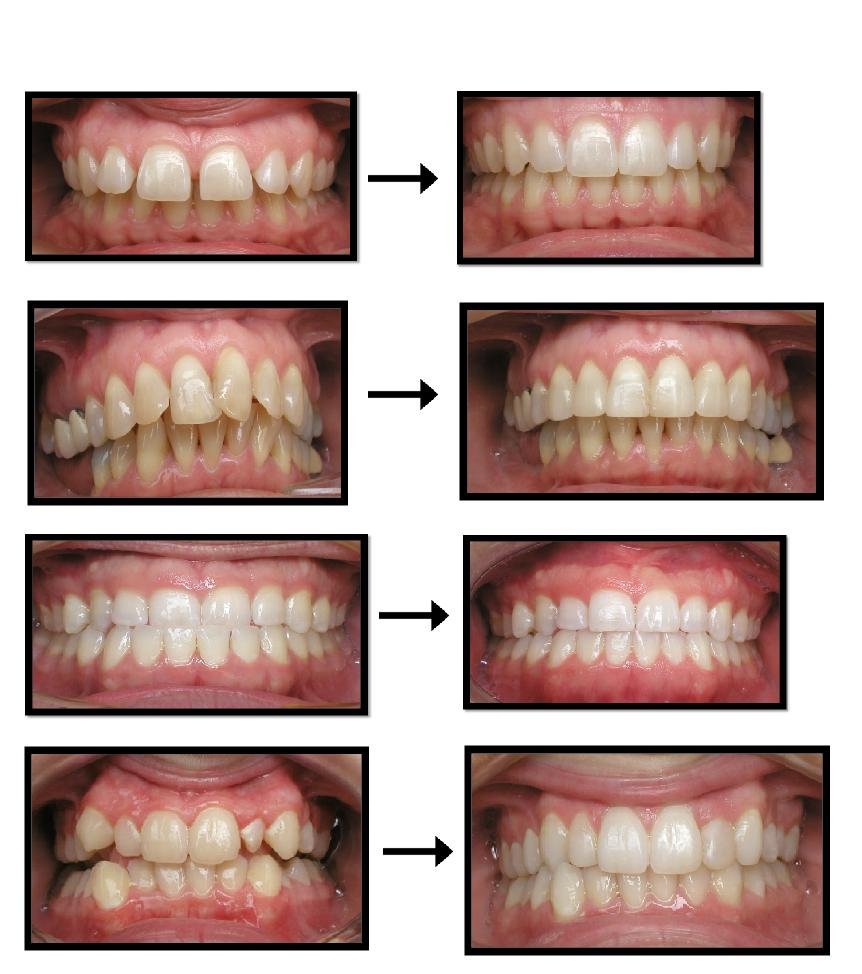 BC-Invisalign-Before-and-After-Photos