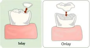 Inlays and Overlays