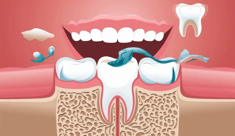 What Causes Tooth Pocket Formation